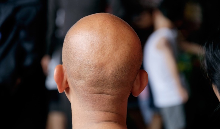 Kenapa Orang Botak Selalu Bahagia